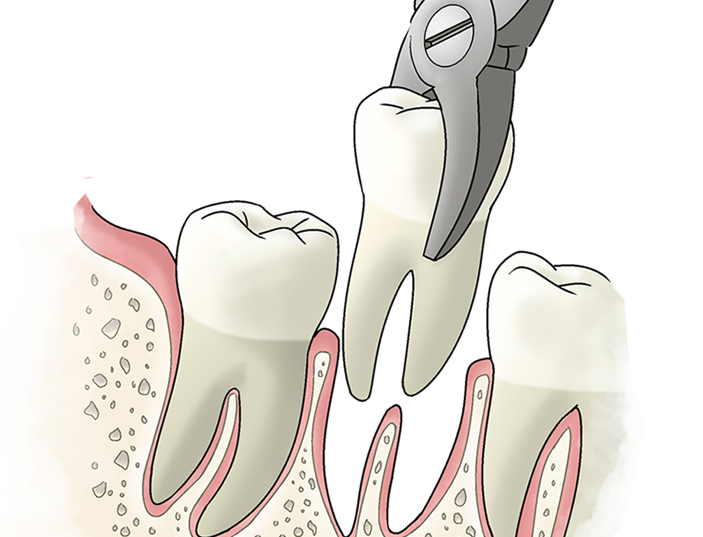 Tooth Extractions